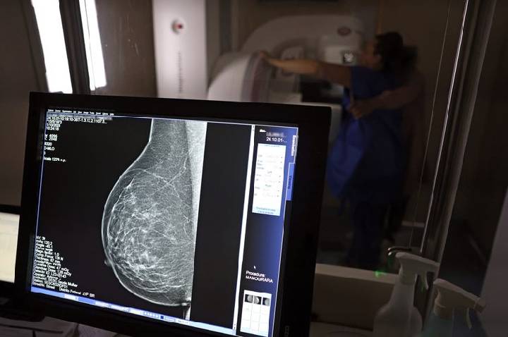 Falta de acesso a mamógrafos limita prevenção do câncer de mama